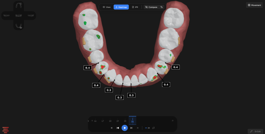 3D Occlusion Contact Heatmap & IPR Callouts